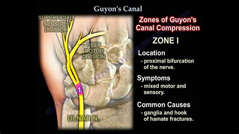 guyon's canal compression test|treatment for guyon's canal syndrome.